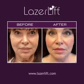 Laser neck lift addresses loose and sagging skin utilizing advanced laser technology. LazerLift® neck lift eliminates the appearance of a double chin and smoothens neck bands to restore a younger appearance. LazerLift® is minimally-invasive and requires little-to-no downtime, with exceptional results.