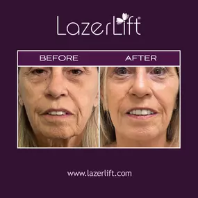 Facelift surgery can address fine lines, wrinkles, and sagging. LazerLift® utilizes laser technology to target the lower face to tighten skin, reduce fat, and promote collagen production. A facelift can restore a youthful, natural-looking, and refreshed appearance.