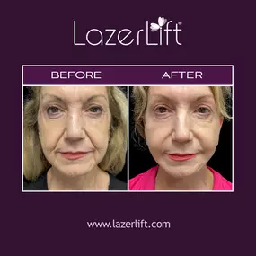 A laser jowl lift uses LazerLift® technology to lift and tighten the jowls, without the use of a scalpel, stitches, or general anesthesia. LazerLift® jowl lift can provide patients with a younger facial profile by removing fat deposits and improving jawline definition.