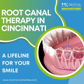 Root Canal Therapy in Cincinnati at Mk Dental Excellence
