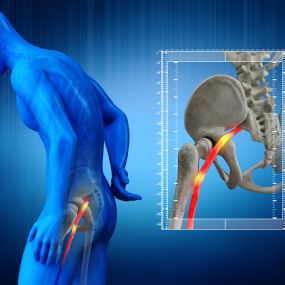 Sciatica, Causes and Treatment