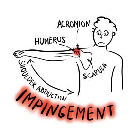 Shoulder Impingement Syndrome Treatment