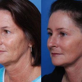 Aesthetic Surgery Center from Naples provide Midface lift surgery is designed to address the cheeks and midface area.