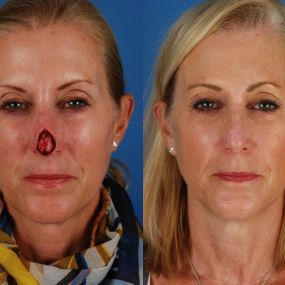 Aesthetic Surgery Center in Naples, FL remove  these skin cancers defects on the face, if not closed with meticulous surgical technique.  The same can apply to skin cancer on the body.