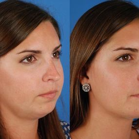 Aesthetic Surgery Center offer  Cheek Surgery in Naples. A cheek implant or mentoplasty is performed either to increase or decrease the size of the chin.