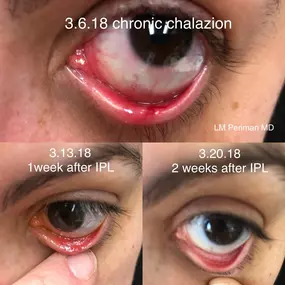 IPL chalazion treatment