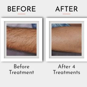 Laser Hair Removal