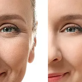 Laser Skin Resurfacing