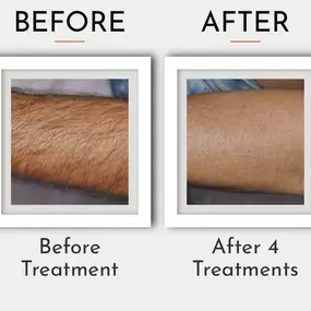 Laser Hair Removal