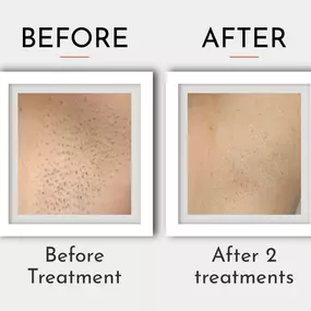 Laser Hair Removal