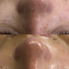 This is a before and after photo of our extraction process. Helping you look your best!