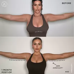 Two-Month Arm AirSculpt Before and After