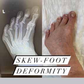 Skew Foot Deformity Specialist Miami FL