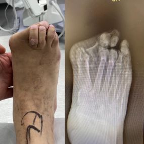 Foot Reconstruction Surgery Miami FL
