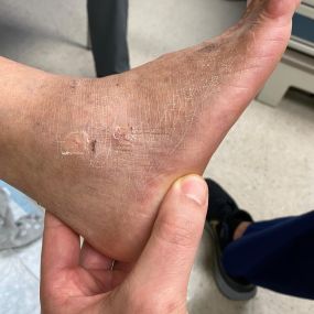Minimally Invasive Ankle Repair Miami FL