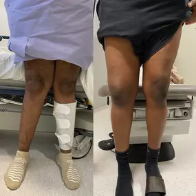 Knock Knees Correction Miami FL
