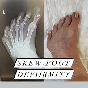 Skew Foot Deformity Specialist Miami FL