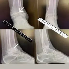 Ankle Arthritis Specialist Miami FL