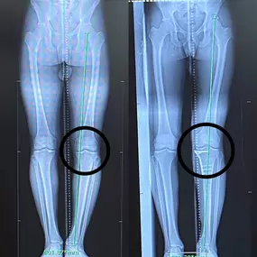 Bow Leg Correction Surgery Miami FL