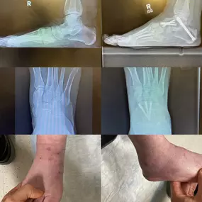 Flatfoot Reconstruction Miami FL