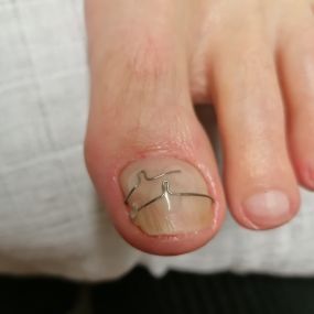 Behandeling ingegroeide nagel
