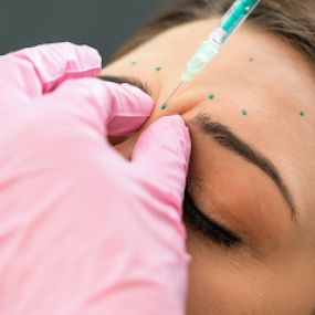 RN Esthetics is among the top providers of BOTOX® + Dysport® in the nation. We use a conservative approach to treatment. Our team does not subscribe to the frozen look, but rather treat to strategically soften areas of the face for a natural result.