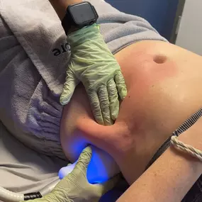 Cryo Slimming