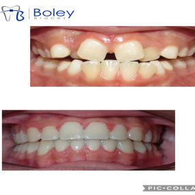 Bild von Boley Braces