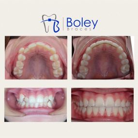 Bild von Boley Braces