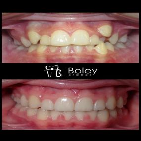 Bild von Boley Braces