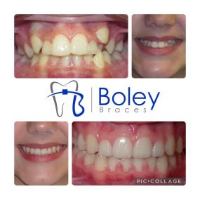 Bild von Boley Braces