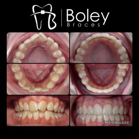 Bild von Boley Braces