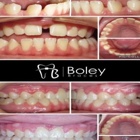 Bild von Boley Braces