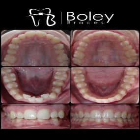 Bild von Boley Braces