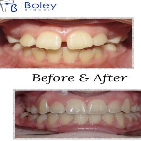 Bild von Boley Braces