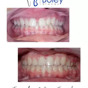 Bild von Boley Braces