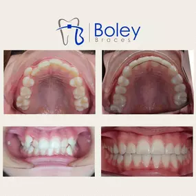 Bild von Boley Braces