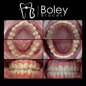 Bild von Boley Braces