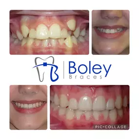 Bild von Boley Braces