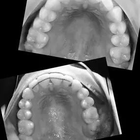 Bild von Boley Braces