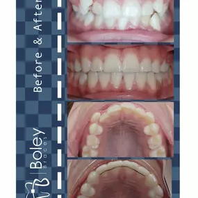 Bild von Boley Braces