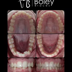 Bild von Boley Braces