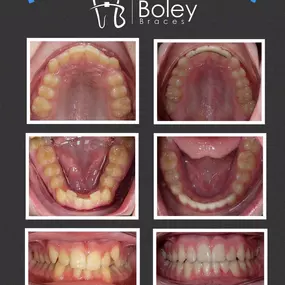 Bild von Boley Braces