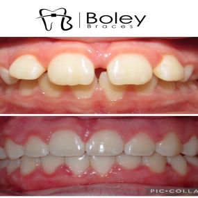 Bild von Boley Braces