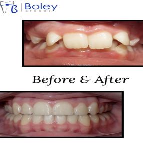 Bild von Boley Braces