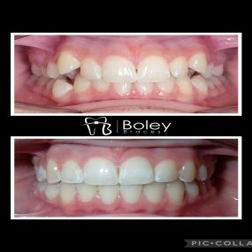 Bild von Boley Braces