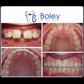 Bild von Boley Braces