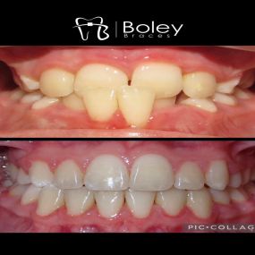 Bild von Boley Braces