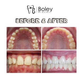 Bild von Boley Braces