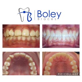 Bild von Boley Braces